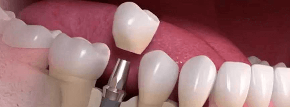 Протезирование зубов: какой протез лучше выбрать